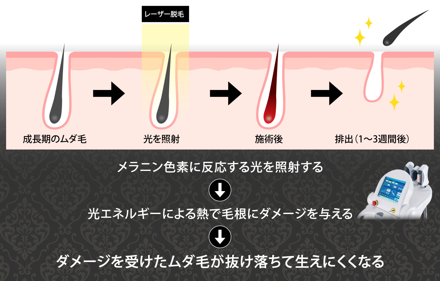 脱毛のしくみ